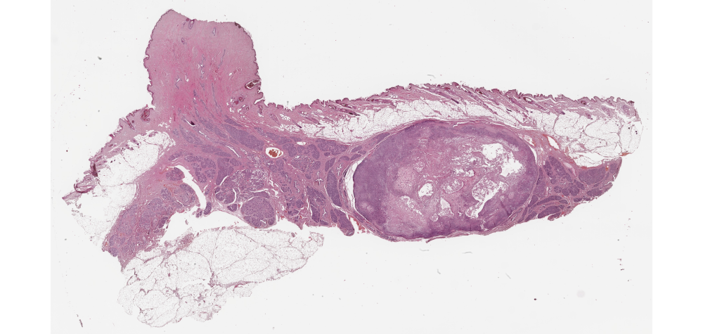 Mikroskopie-Aufnahme (Whole-Slide-Image) eines Brusttumors. Zur Beurteilung der Bösartigkeit benötigt man eine höhere Vergrößerung.