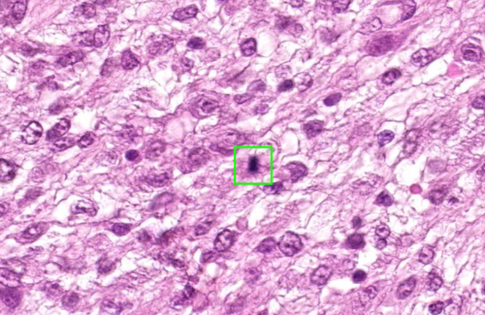 Nahaufnahme von Gewebe aus dem Tumor. Markiert ist eine Zelle, die sich gerade im Prozess der Zellteilung (Mitose) befand. Eine hohe Dichte daran verrät, dass Zellteilung in großem Maße statt findet, was auf Bösartigkeit des Tumors hinweist.