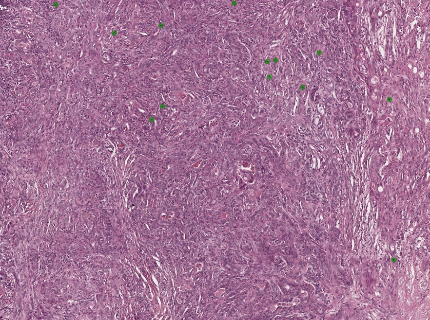 Gewebeausschnitt (geringere Vergrößerung) in dem Mitosefiguren in grün hervorgehoben sind. Die Dichte an Mitosefiguren wird klar erkennbar. Eine solche Übersichtsanalyse wäre ohne KI-Algorithmen undenkbar.